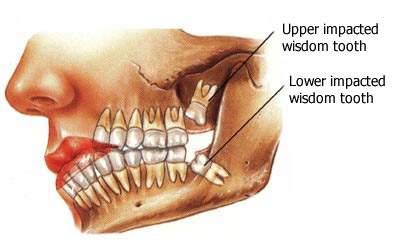 Các biến chứng khi mọc răng số 8, hạn chế nhổ răng số 8 trong trường hợp nào?