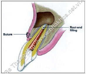 Sâu răng nhiễm trùng tủy răng, chấn thương răng gây Viêm chóp chân răng-Xử-trí