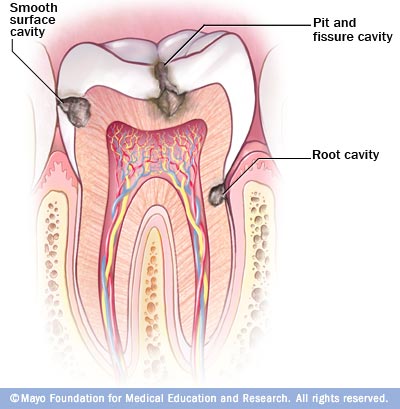 Bệnh sâu răng: Triệu chứng và phòng bệnh