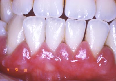Các bệnh gây chảy máu khi chải răng