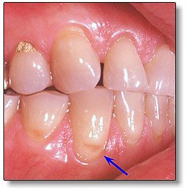 Mòn cổ răng: Phòng bệnh và điều trị