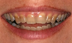 Hậu quả của Tetracycline trên răng và các cách phục hồi vẻ thẩm mỹ cho răng