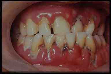 Mảng bám thân răng, cao răng là gì?