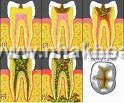 Bệnh sâu răng: dịch tễ, định nghĩa, nguyên nhân