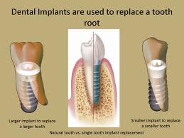 Cấu trúc của răng cấy ghép Implant nha khoa
