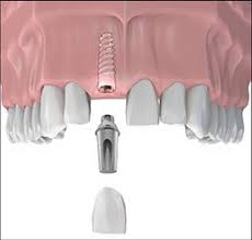Mô tả nhanh 3 bước làm răng Implant