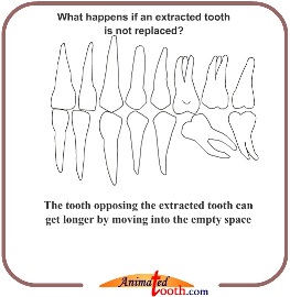 Hậu quả xô lệch răng sau mất răng hàm