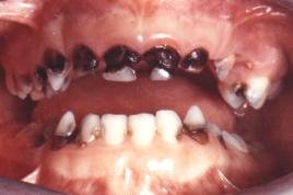 Bệnh sún răng ở trẻ
