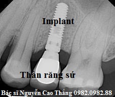 Giá làm răng implant được cấy bởi BacsiThang NguyenCao