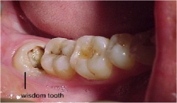 Nên nhổ răng khôn khi nào?