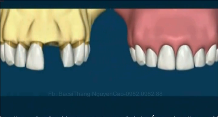 So sánh Làm cầu răng sứ và Làm răng Implant nha khoa