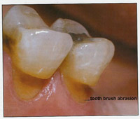 Phòng và điều trị mòn răng
